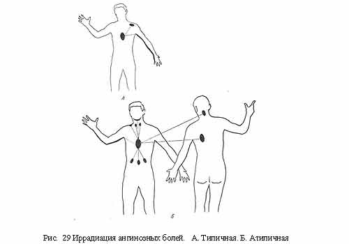 Ангиозные боли при стенокардии
