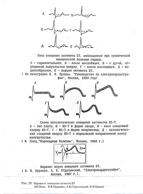 Вариант смещения сегмента ST