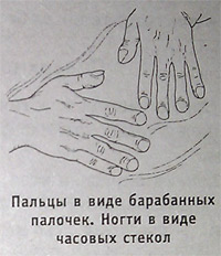 Пальцы в виде барабанных палочек