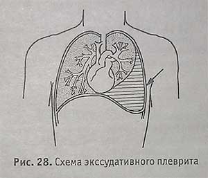 Схема экссудативного плеврита