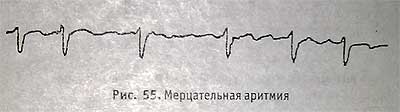 Мерцатеьная артитмия