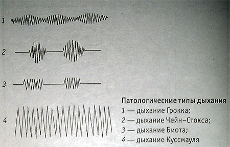 Патологические типы дыхания