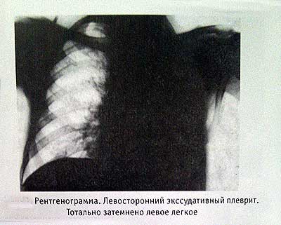 Плеврит