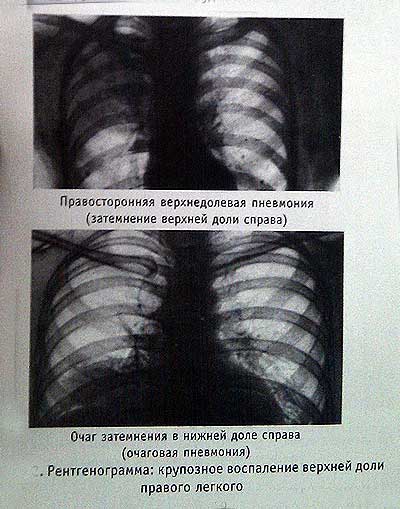 Пневмония