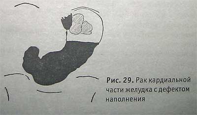 Рак кардиальной части желудка