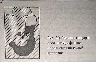 Рак тела желудка