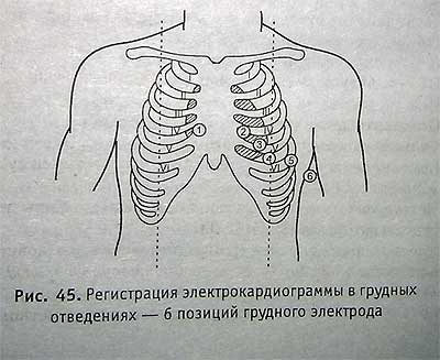 Регистрация ЭКГ