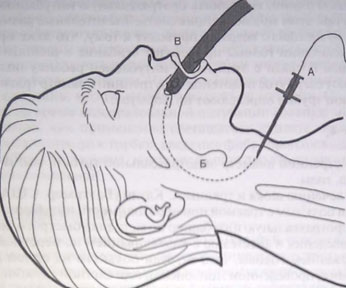 Ретроградная интубация трахеи