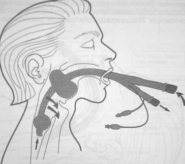 Положение ларингеальной маски в дыхательных путях